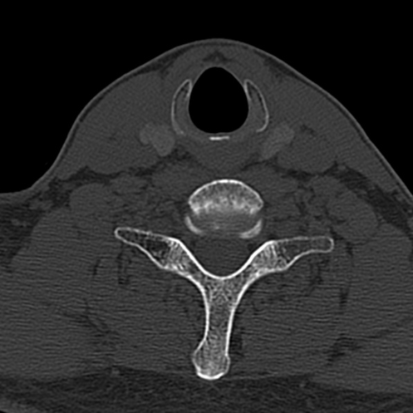 Cervical spondylodiscitis (Radiopaedia 28057-29489 Axial bone window 58).jpg