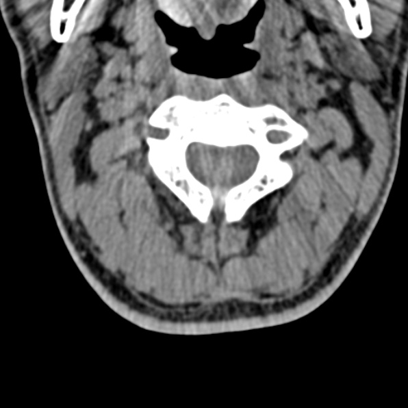 Cervical spondylodiscitis (Radiopaedia 28057-29489 Axial non-contrast 26).jpg