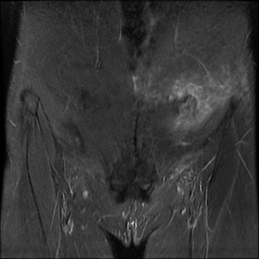 File:Cesarian section scar endometriosis (Radiopaedia 66520-75799 Coronal STIR 5).jpg
