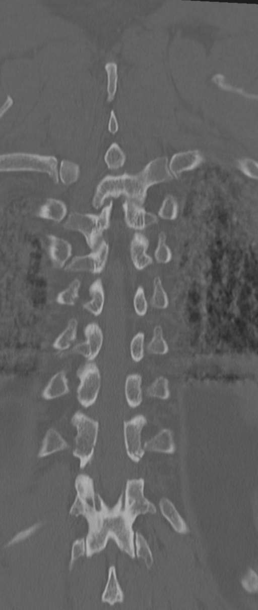 Chance fracture (Radiopaedia 33854-35020 Coronal bone window 66).png
