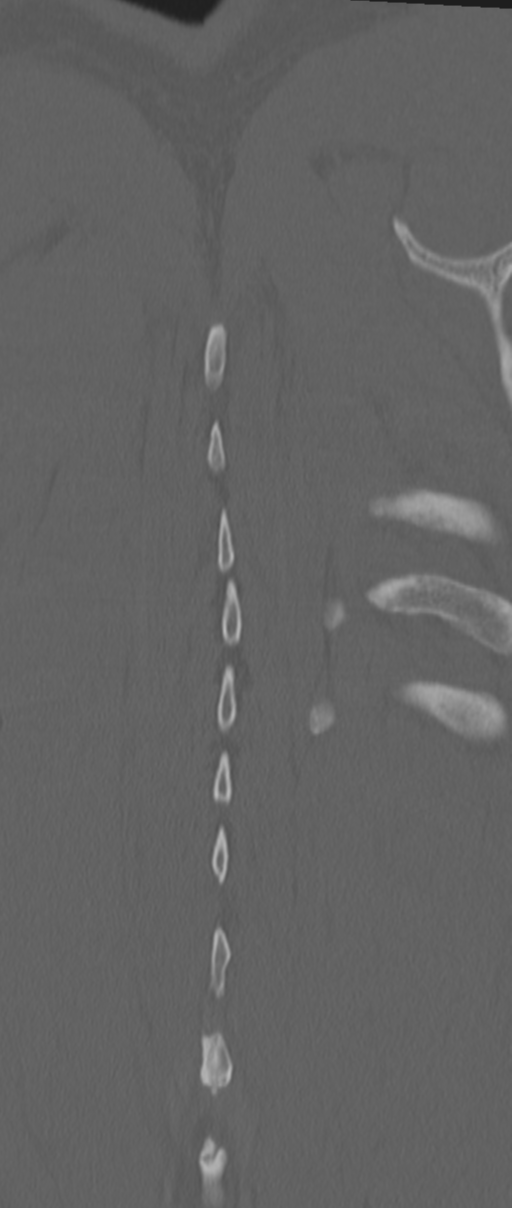 Chance fracture (Radiopaedia 33854-35020 Coronal bone window 79).png