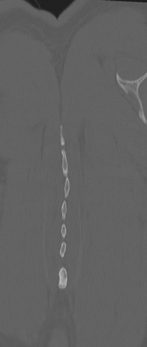 Chance fracture (Radiopaedia 33854-35020 Coronal bone window 83).png