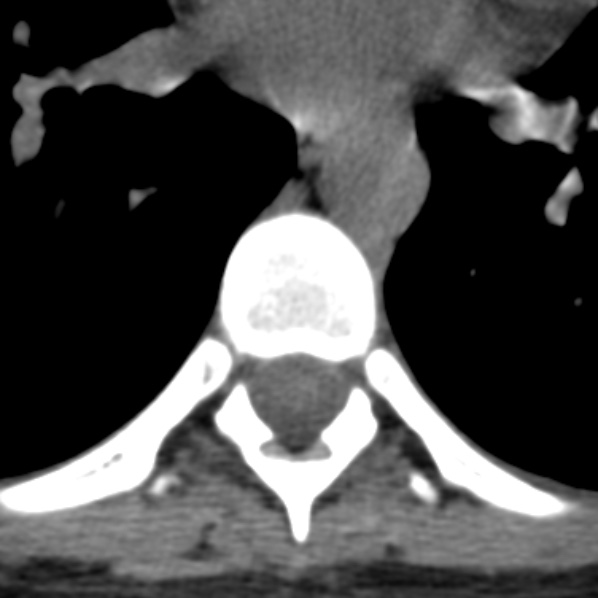 File:Chance fracture (Radiopaedia 36521-38081 Axial non-contrast 14).jpg