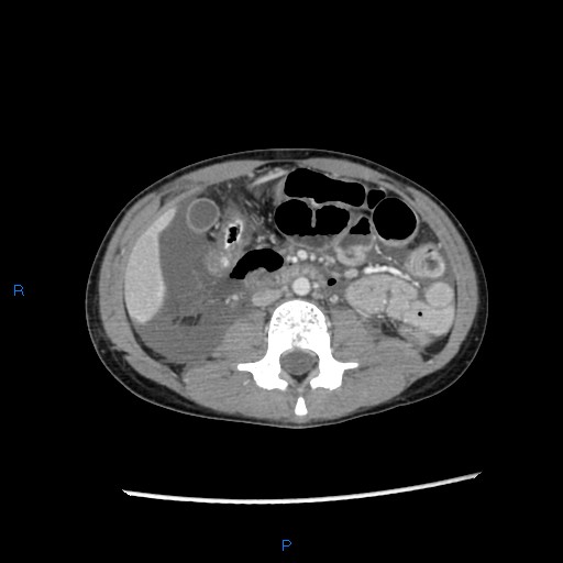 File:Chance fracture with duodenal and pancreatic lacerations (Radiopaedia 43477-46864 A 21).jpg