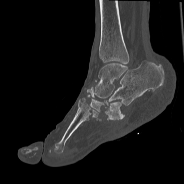 Charcot joint (Radiopaedia 36629-38194 Sagittal bone window 49).jpg