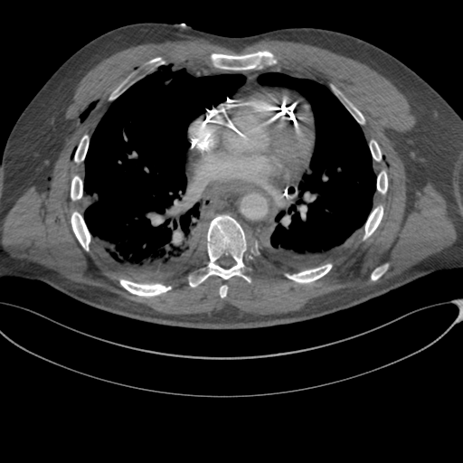 File:Chest multitrauma - aortic injury (Radiopaedia 34708-36147 A 169).png
