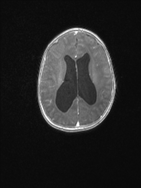 Chiari III malformation with occipital encephalocele (Radiopaedia 79446-92559 Axial T1 C+ mpr 58).jpg