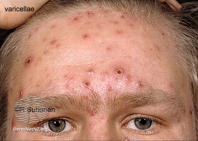File:Chickenpox (DermNet NZ viral-s-varicella127).jpg