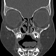 File:Choanal atresia (Radiopaedia 88525-105975 Coronal bone window 21).jpg