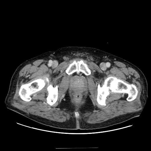 Choledocholiathiasis with normal caliber common bile duct (Radiopaedia 75368-86632 A 191).jpg
