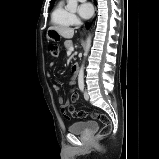 Choledocholiathiasis with normal caliber common bile duct (Radiopaedia 75368-86632 D 86).jpg