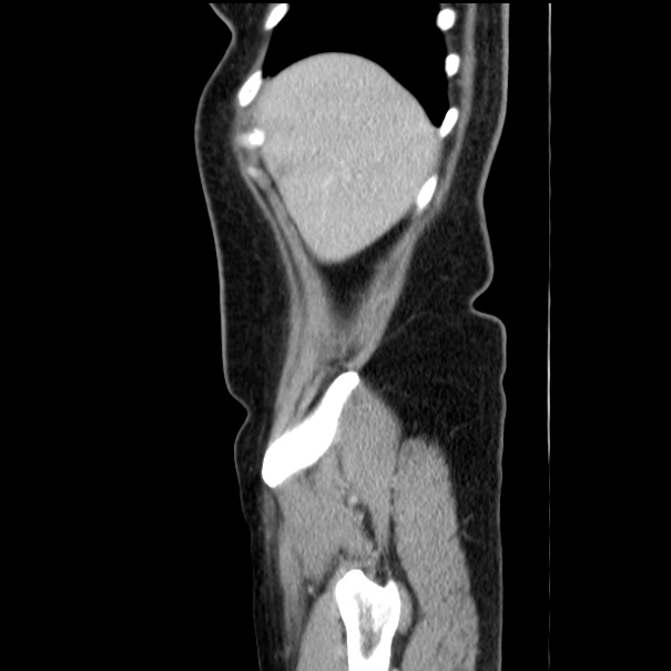 Choledocholithiasis on CT and MRI (Radiopaedia 24825-25087 D 10).jpg