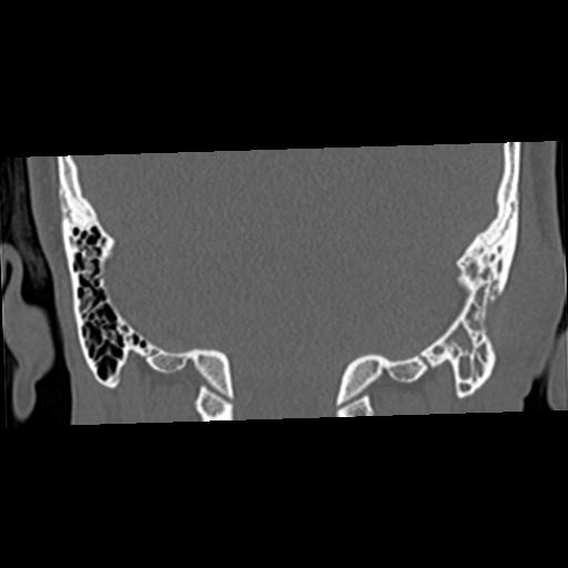 Cholesteatoma (Radiopaedia 84960-100474 Coronal bone window 51).jpg
