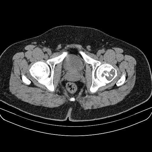 File:Chondroblastoma (Radiopaedia 12264-12563 Axial non-contrast 5).jpg