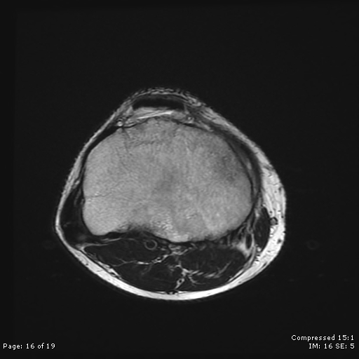 File:Chondroblastoma (Radiopaedia 25725-25891 Axial T2 16).jpg
