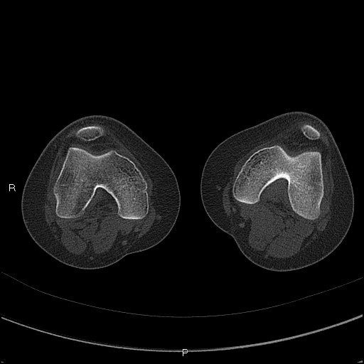Chondroblastoma (Radiopaedia 62721-71030 Axial bone window 18).jpg