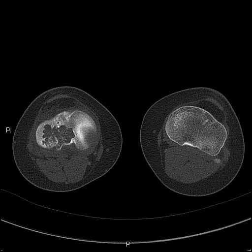 File:Chondroblastoma (Radiopaedia 62721-71030 Axial bone window 47).jpg