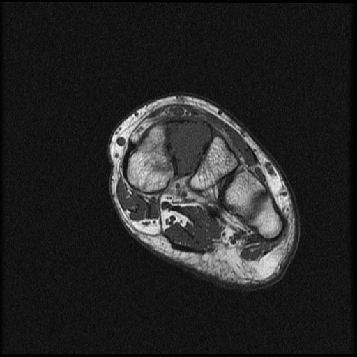File:Chondroblastoma - midfoot (Radiopaedia 64831-73765 Short axis T1 15).jpg