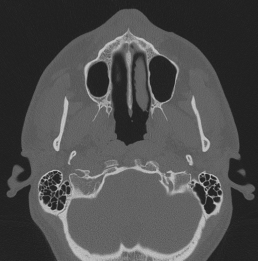 Chondrosarcoma (clivus) (Radiopaedia 46895-51425 Axial bone window 71).png