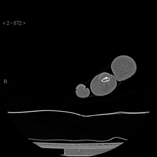 File:Chondrosarcoma - phalanx (Radiopaedia 69047-78812 Axial bone window 126).jpg