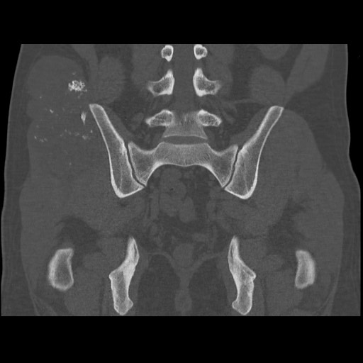 File:Chondrosarcoma of iliac wing (Radiopaedia 63861-72599 Coronal bone window 76).jpg