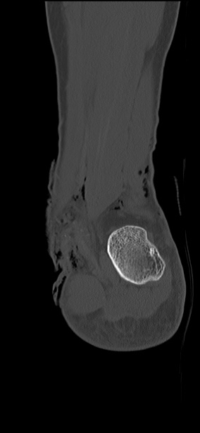Chopart fracture (Radiopaedia 35347-36851 Coronal bone window 18).jpg