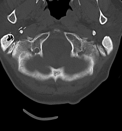 Chordoma (C4 vertebra) (Radiopaedia 47561-52188 Axial bone window 4).png