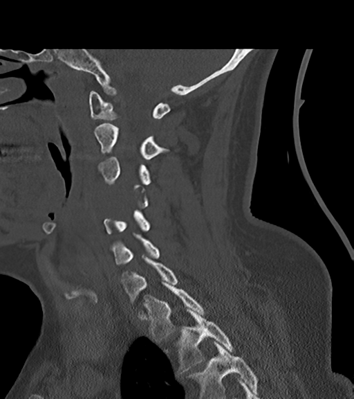 File:Chordoma (C4 vertebra) (Radiopaedia 47561-52188 Sagittal bone window 47).png