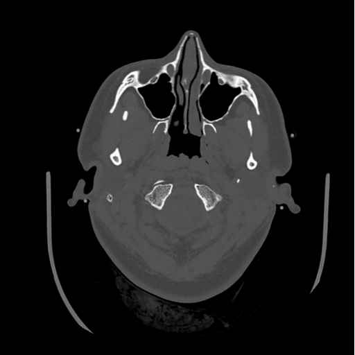 Choroid plexus papilloma extending into the cerebellopontine angle cistern (Radiopaedia 85941-101833 Axial bone window 16).png