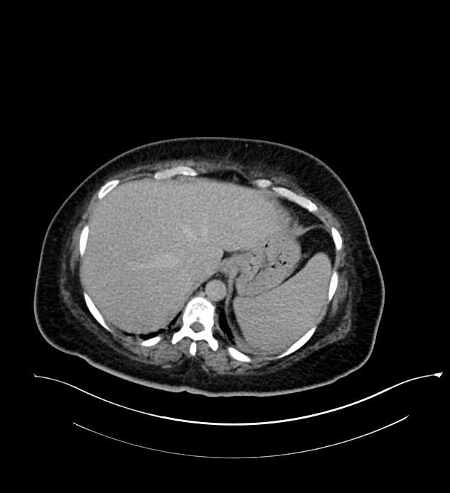 Chromophobe renal cell carcinoma (Radiopaedia 84239-99519 E 36).jpg