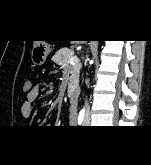 Chromophobe renal cell carcinoma (Radiopaedia 84286-99573 F 86).jpg