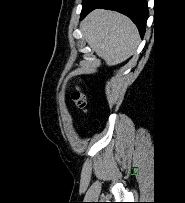 Chromophobe renal cell carcinoma (Radiopaedia 84286-99573 I 171).jpg