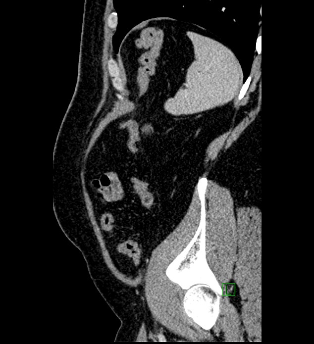 Chromophobe renal cell carcinoma (Radiopaedia 84286-99573 I 28).jpg