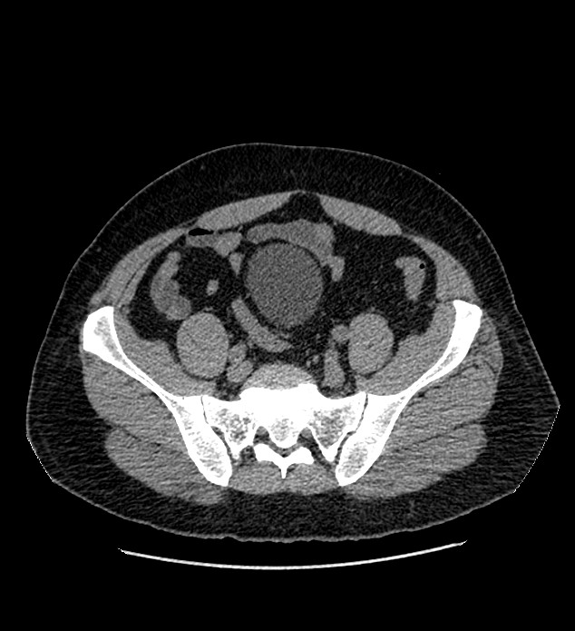 Chromophobe renal cell carcinoma (Radiopaedia 84337-99693 Axial non-contrast 120).jpg