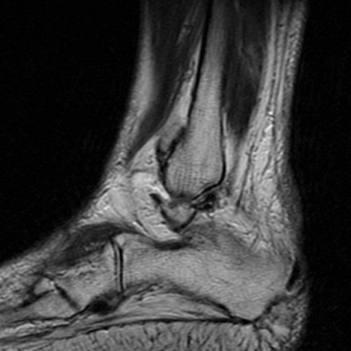 File:Chronic Achilles tendon rupture (Radiopaedia 15262-15100 Sagittal T2 2).jpg