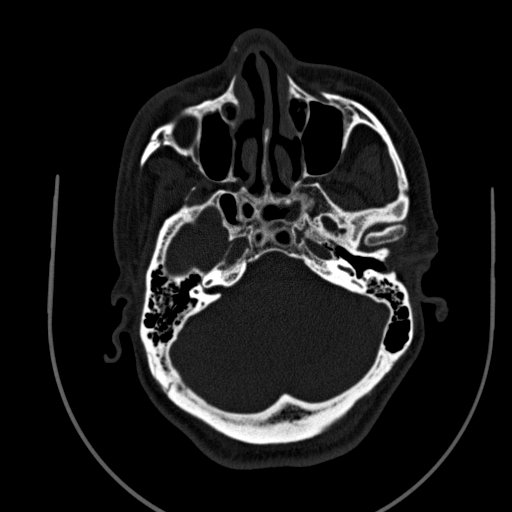 Chronic invasive fungal sinusitis (Radiopaedia 91563-109286 Axial sinus 41).jpg