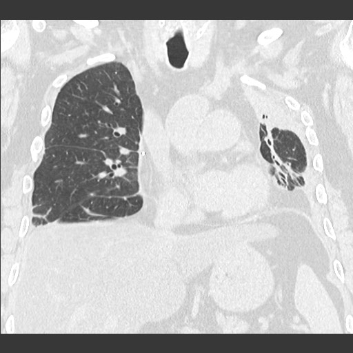 Chronic lung allograft dysfunction - restrictive form (Radiopaedia 60595-68316 Coronal lung window 51).jpg