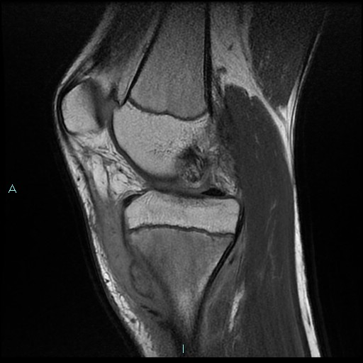 File:Chronic osteomyelitis (with Brodie abscess) (Radiopaedia 76405-88112 Sagittal PD 10).jpg