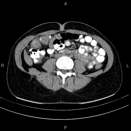Chronic pancreatitis (Radiopaedia 64576-73450 Axial non-contrast 96).jpg