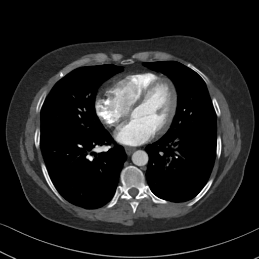 Chronic pulmonary embolus (Radiopaedia 39129-41341 Axial C+ CTPA 65).png