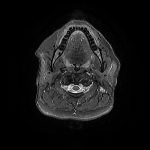 File:Chronic submandibular sialadenitis (Radiopaedia 61852-69885 Axial STIR 11).jpg