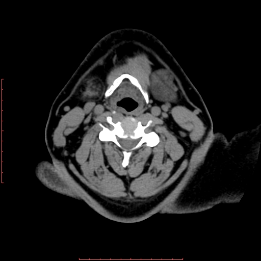 Chronic submandibular sialolithiasis (Radiopaedia 69817-79814 Axial non-contrast 142).jpg