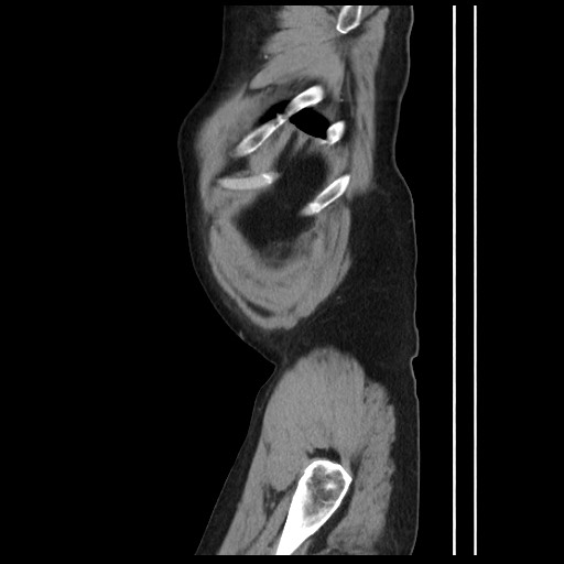 Chyluria following renal ablation (Radiopaedia 81087-94678 B 184).jpg