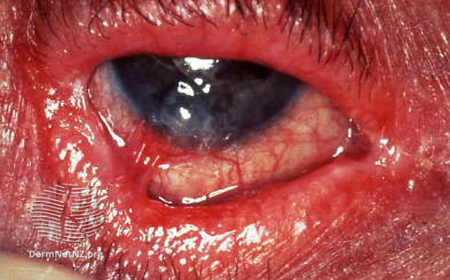 File:Cicatricial pemphigoid (DermNet NZ immune-cic-pem2).jpg