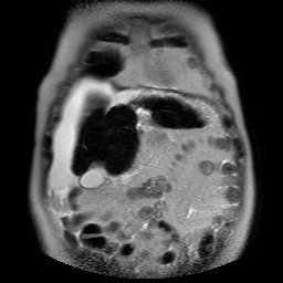 File:Cirrhosis and hepatocellular carcinoma in the setting of hemochromatosis (Radiopaedia 75394-86594 Coronal T2 6).jpg