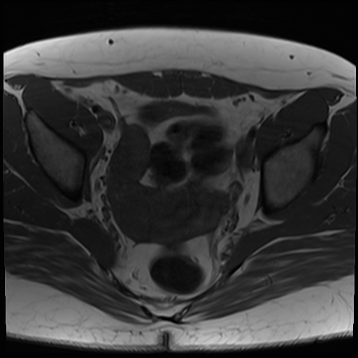 File:Class II Mullerian duct anomaly- unicornuate uterus with rudimentary horn and non-communicating cavity (Radiopaedia 39441-41755 Axial T1 16).jpg