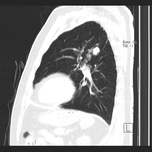 Classic complicated silicosis (Radiopaedia 49720-54961 Sagittal lung window 19).jpg