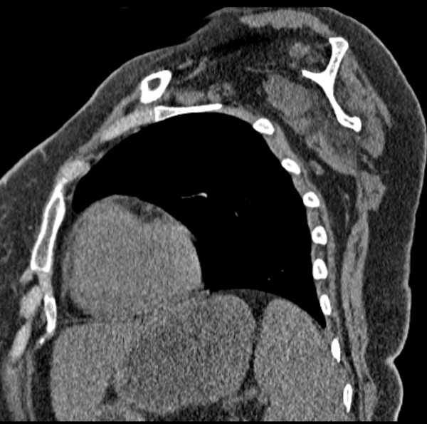 Clear cell chondrosarcoma - humerus (Radiopaedia 63104-71612 D 46).jpg