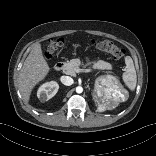 File:Clear cell renal cell carcinoma (Radiopaedia 61449-69393 B 24).jpg