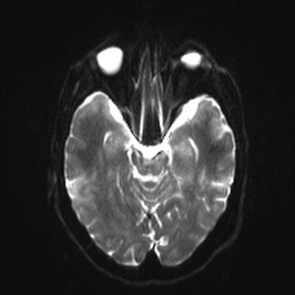 File:Clival meningioma (Radiopaedia 53278-59248 Axial DWI 9).jpg